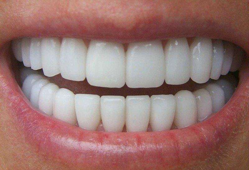 Facetas dentárias